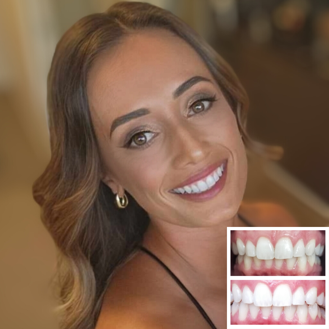 Advanced teeth whitening